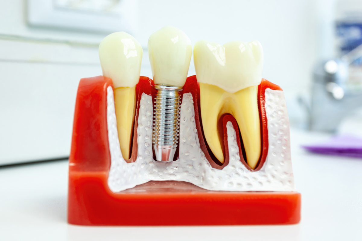 Dental Implants Fountain Hills