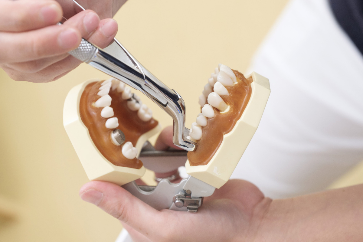 Tooth Extractions Fountain Hills