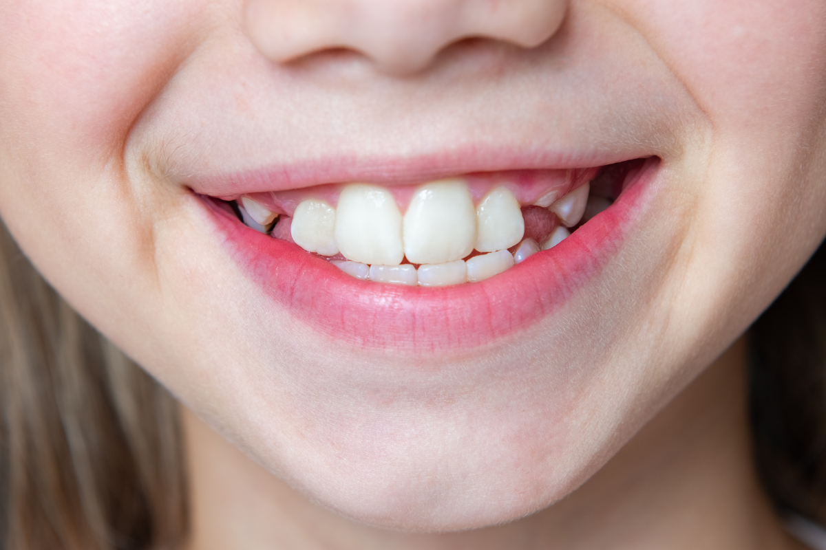 Child's smile showing a missing upper front tooth with healthy white teeth surrounding it.